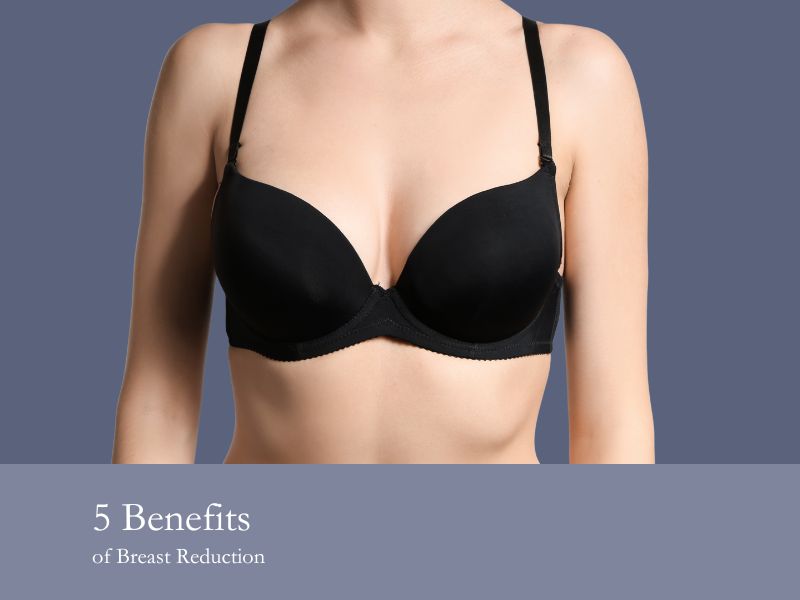 5 Benefits of Breast Reduction