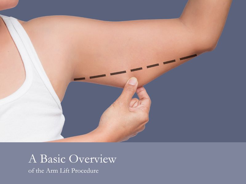 A Basic Overview of the Arm Lift Procedure