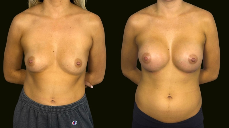 Aventura Before and After Breast Augmentation