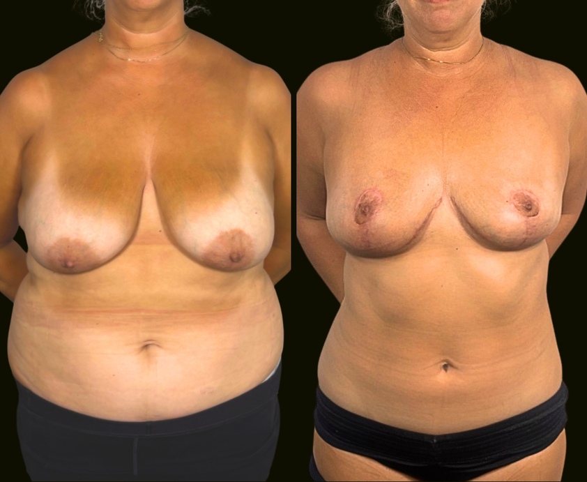Aventura Before and After Mommy Makeover