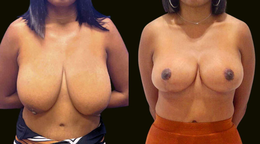 Aventura-Breast-Reduction-Before-and-After-photo