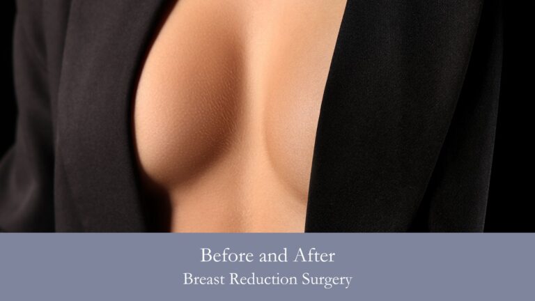 Before and After Breast Reduction Surgery