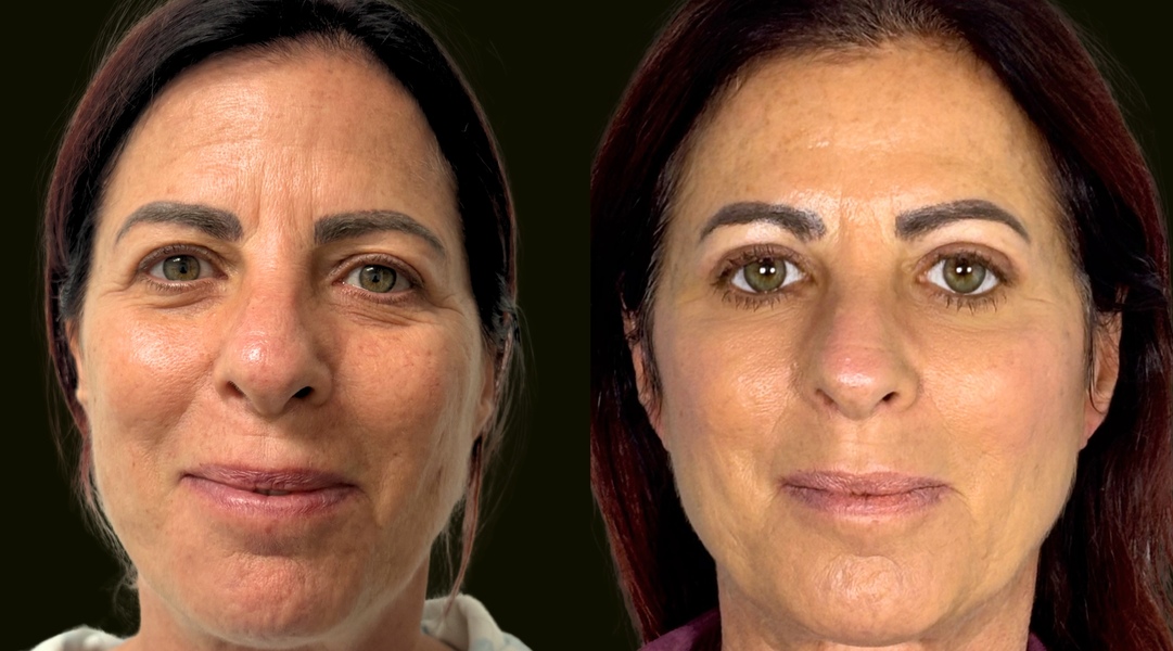 Blepharoplasty Fort Lauderdale Before and After