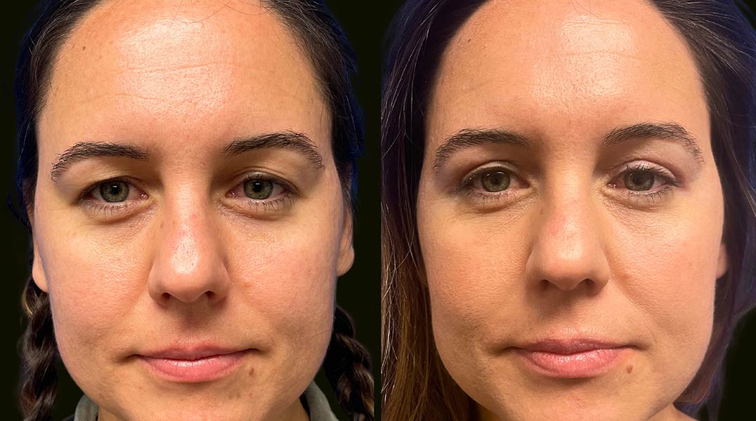 Blepharoplasty Fort Lauderdale Before and After