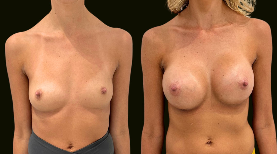Breast-Augmentation-Aventura-Before-and-After-photos