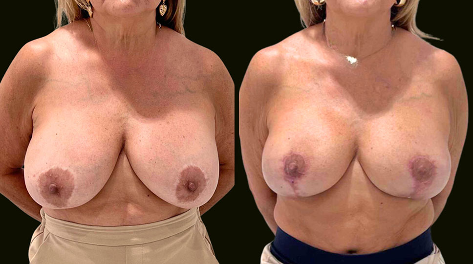 Breast-Implant-Revision-Aventura-Before-and-After