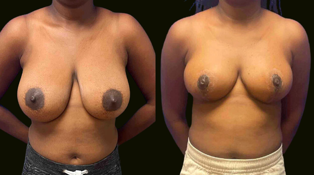 Breast Lift Fort Lauderdale Before and After