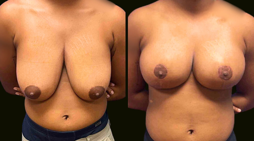 Breast-Reduction-Aventura-Before-and-After-photo