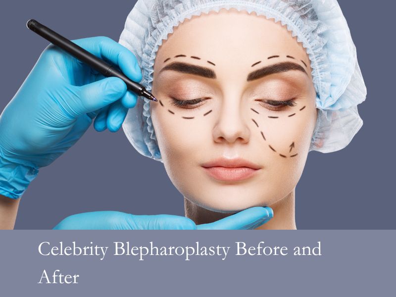 Celebrity Blepharoplasty Before and After