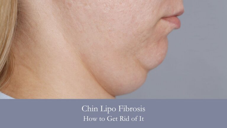 Chin Lipo Fibrosis How to Get Rid of It