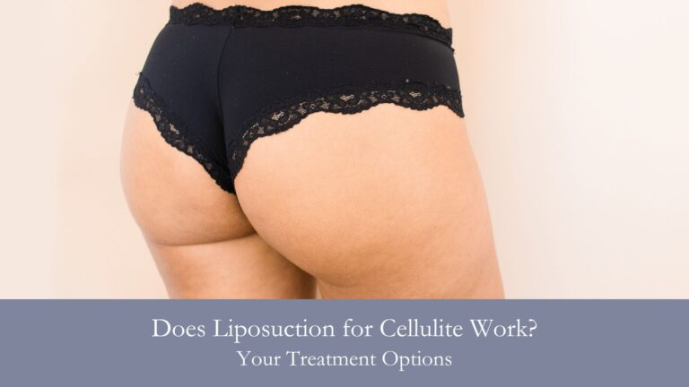 Does Liposuction for Cellulite Work? Your Treatment Options
