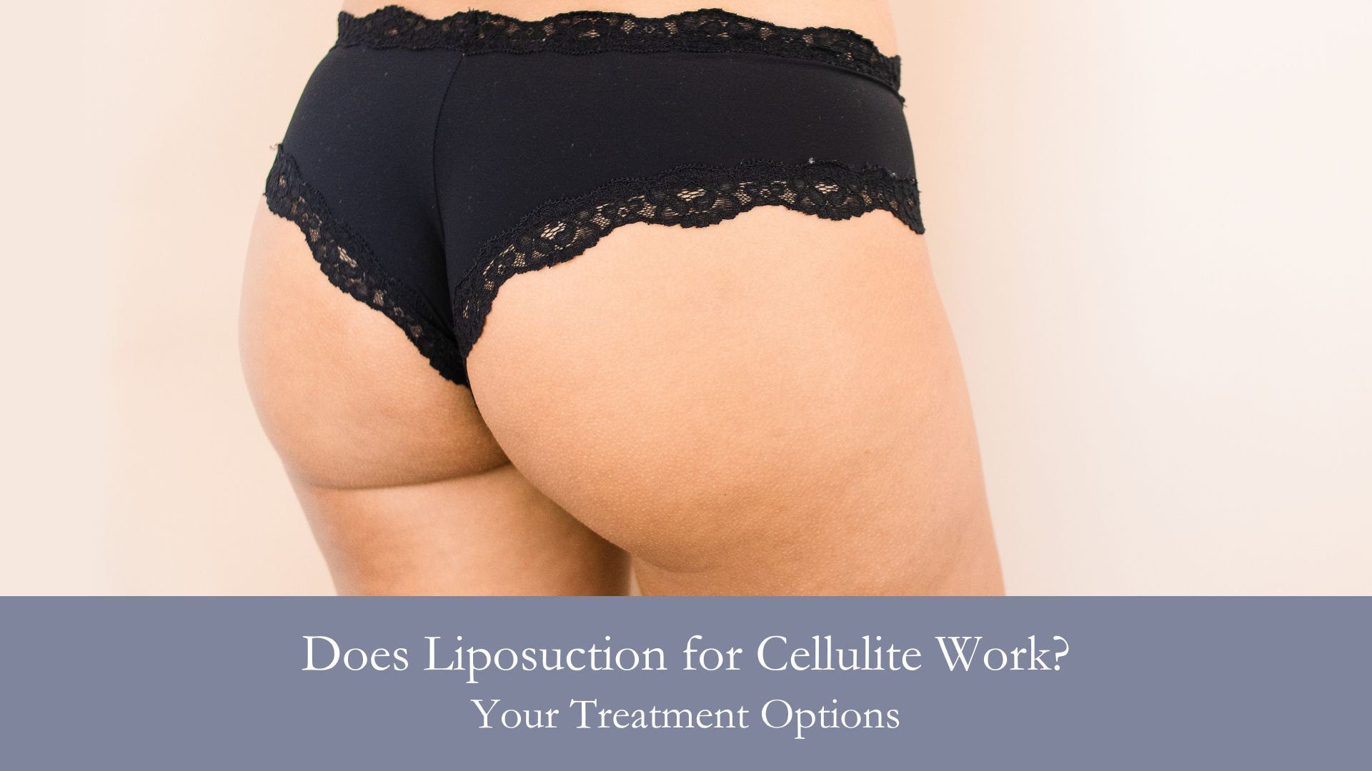 Does Liposuction for Cellulite Work? Your Treatment Options
