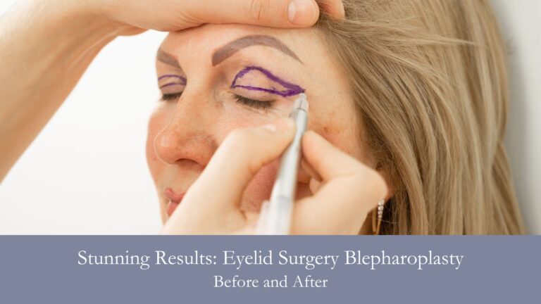 Eyelid Surgery Blepharoplasty Before and After