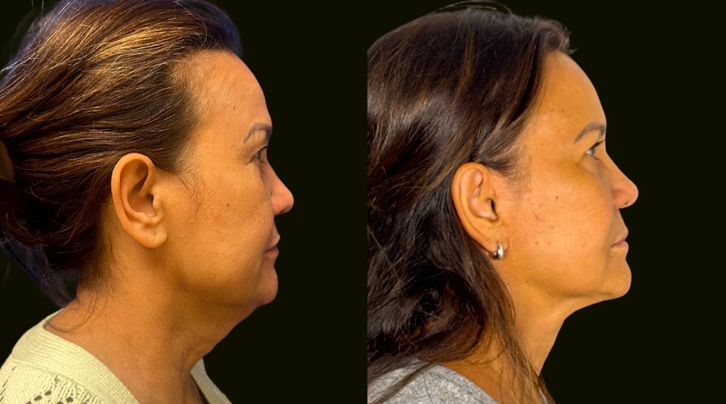Facelift Aventura Before and After