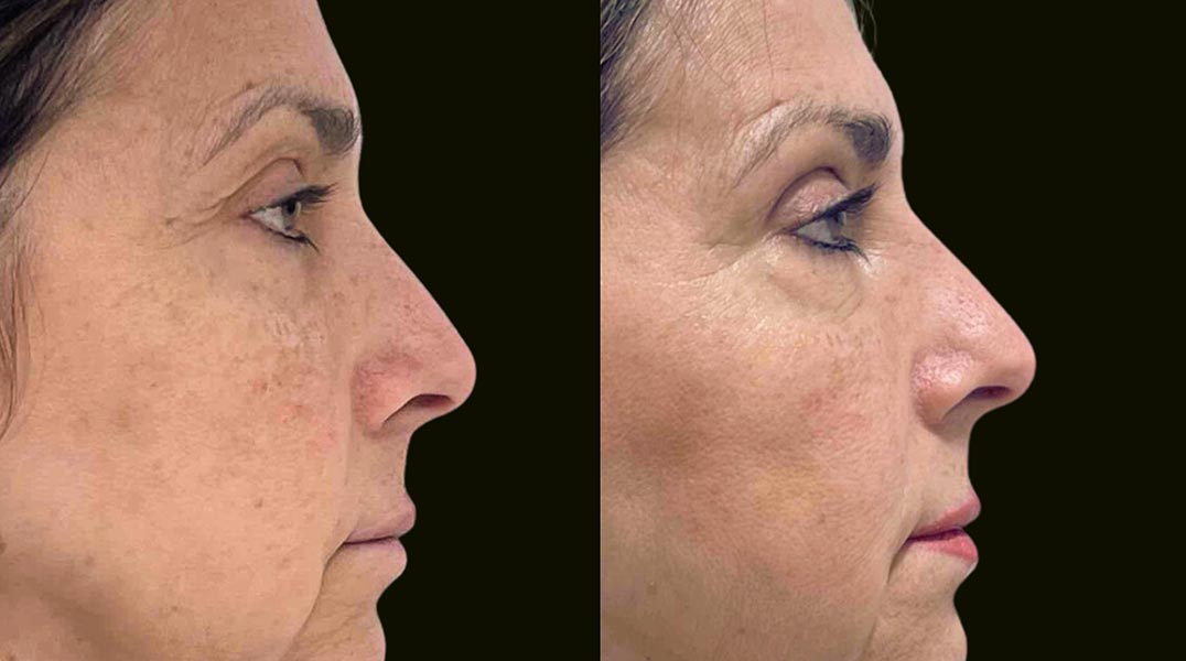 Fort Lauderdale Blepharoplasty Before and After