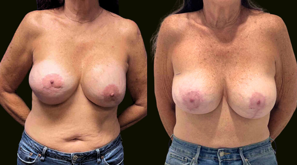 Fort Lauderdale Breast Implant Revision Before and After