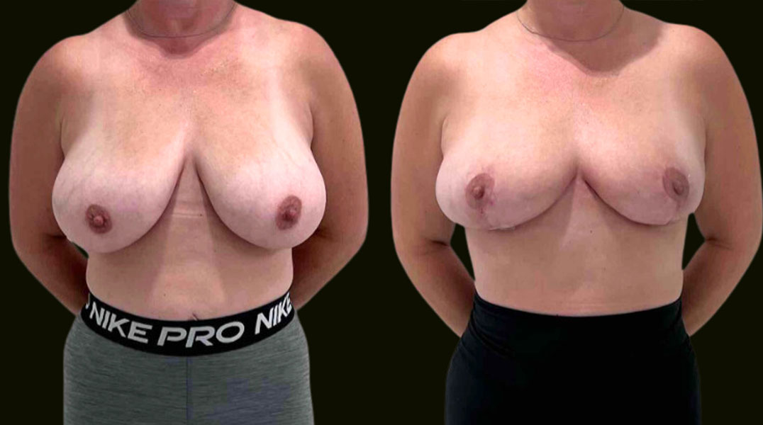 Fort Lauderdale Breast Lift Before and After