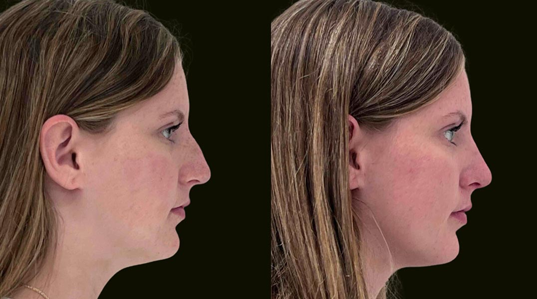 Fort Lauderdale Rhinoplasty Before and After