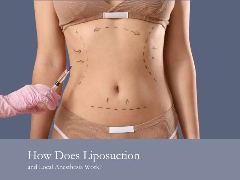 How Does Liposuction and Local Anesthesia Work?