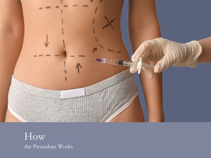 How the Procedure Works