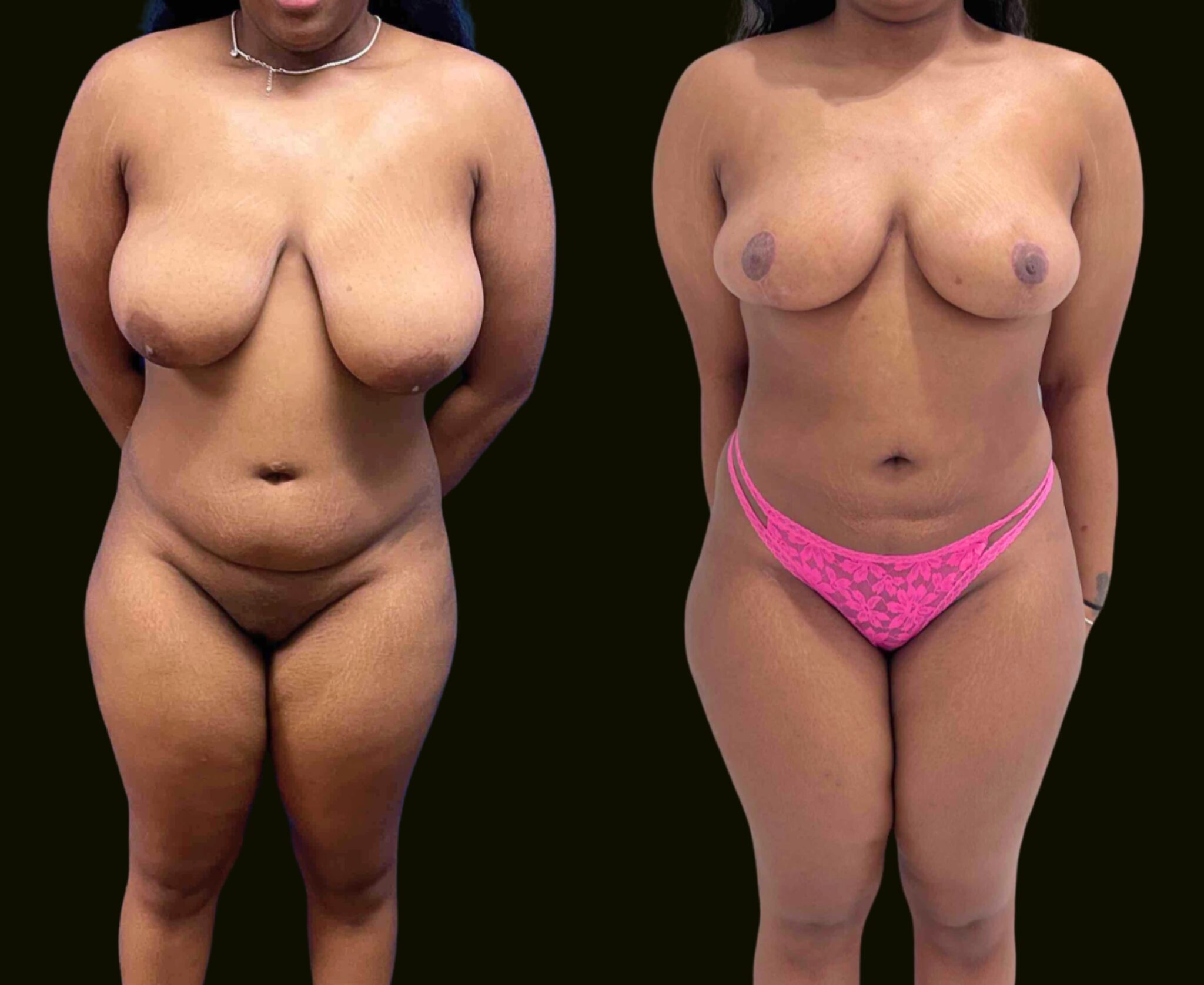 Liposuction Lipo 360 Aventura Before and After