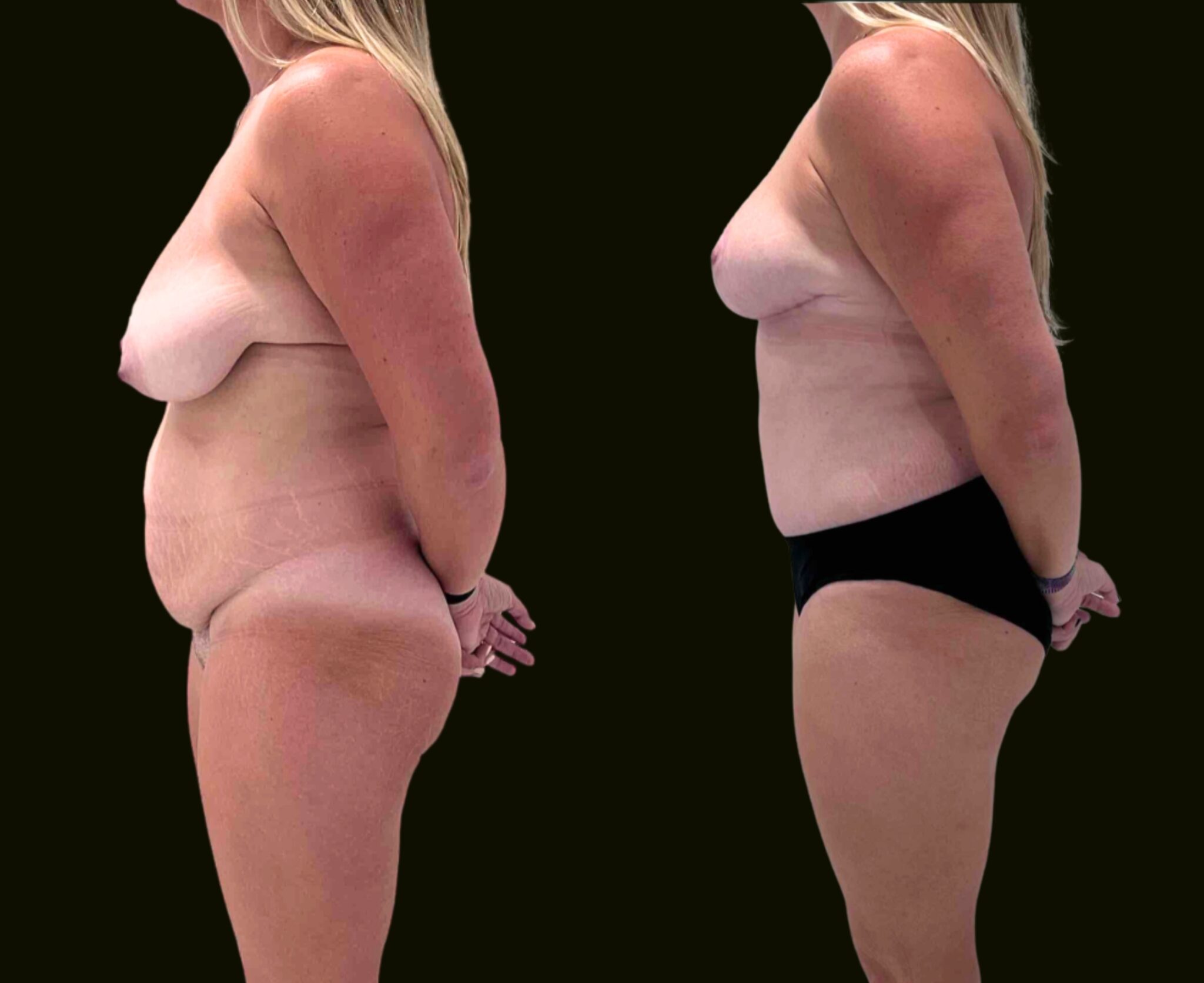 Mommy Makeover Aventura Before and After