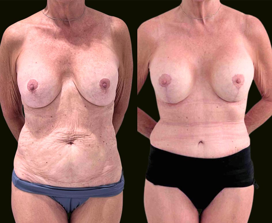 Mommy Makeover Fort Lauderdal Before and After