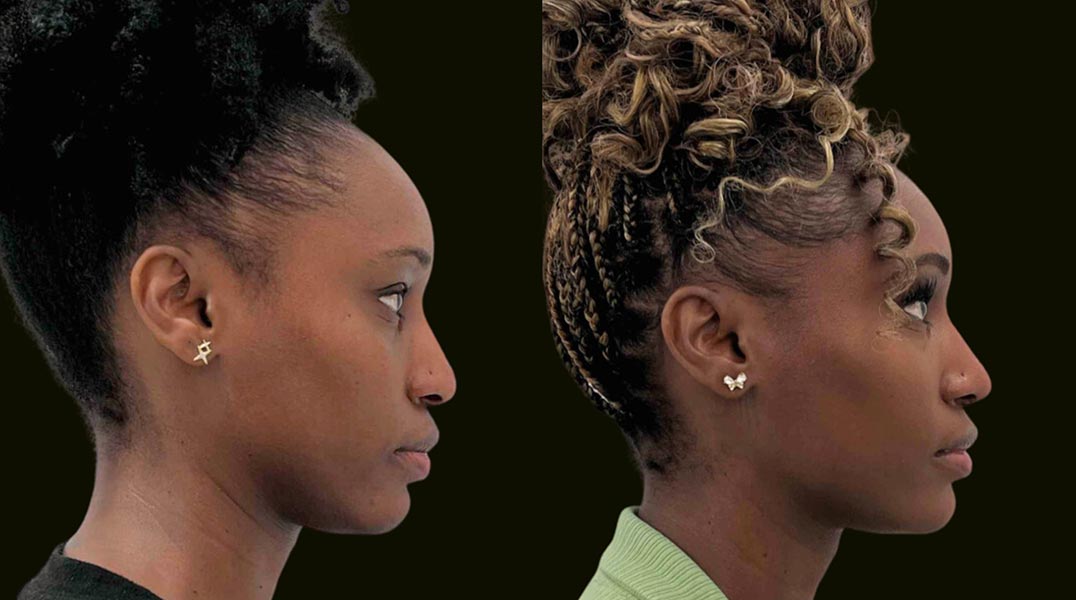 Rhinoplasty Fort Lauderdale Before and After