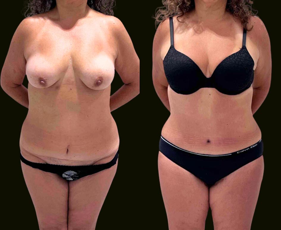 Tummy-Tuck-Aventura-Before-and-After