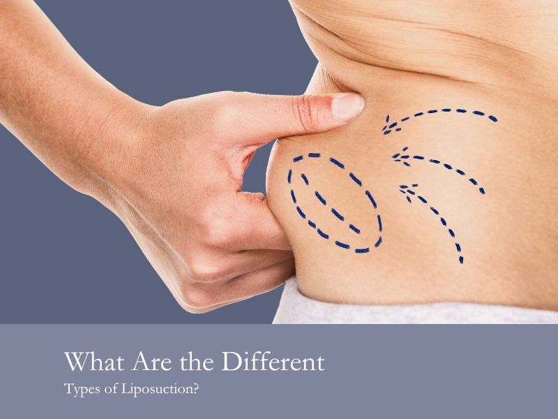 What Are the Different Types of Liposuction?