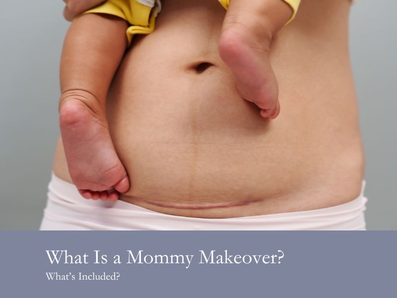 What Is a Mommy Makeover? What’s Included?