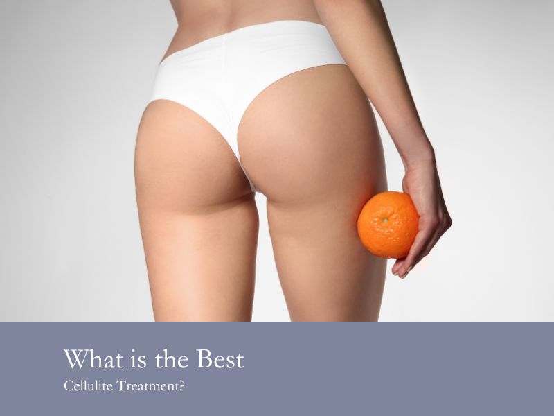 What is the Best Cellulite Treatment?