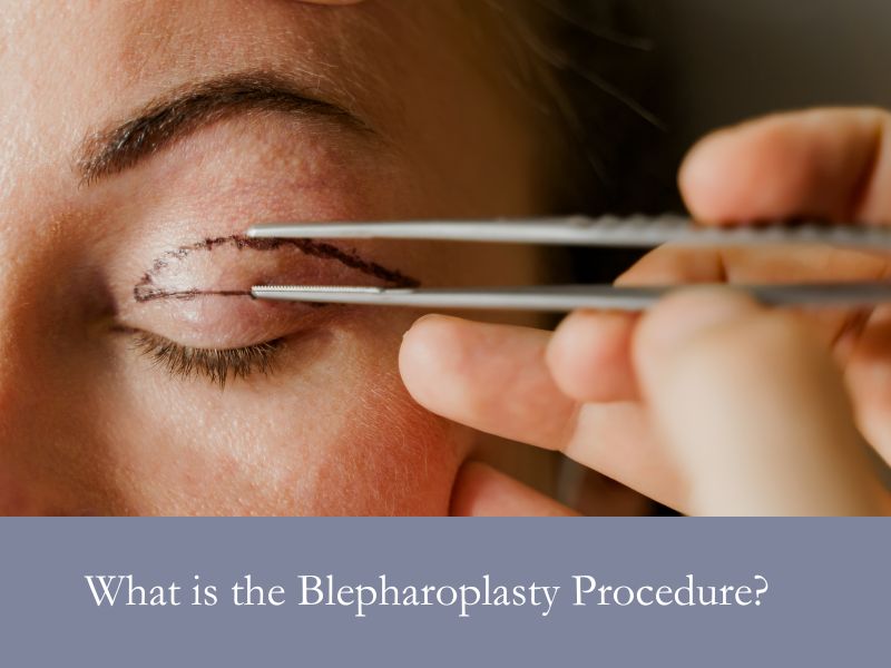 What is the Blepharoplasty