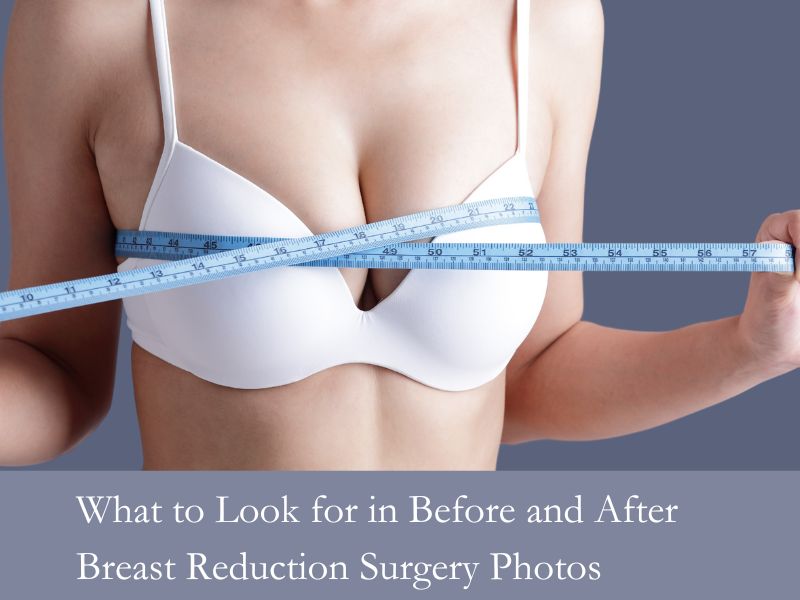 What to Look for in Before and After Breast Reduction Surgery Photos