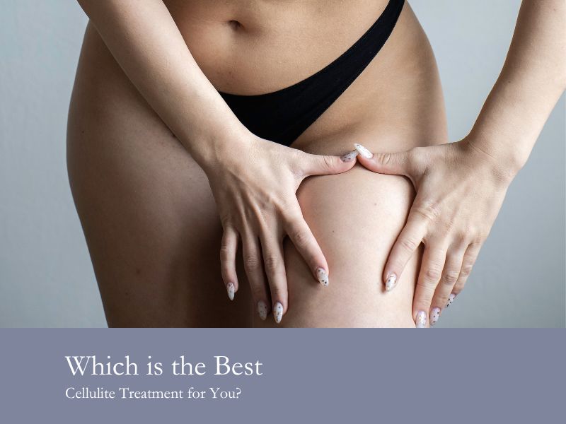 Which is the Best Cellulite Treatment for You?