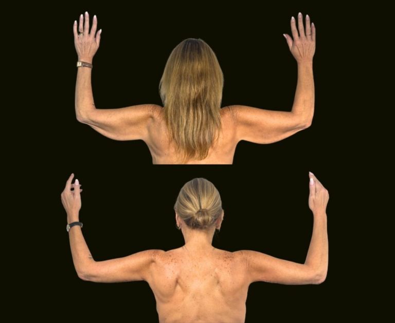 arm lift before and after aventura