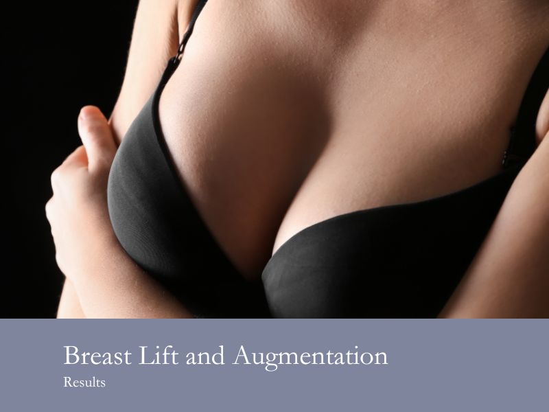 breast lift and augmentation results