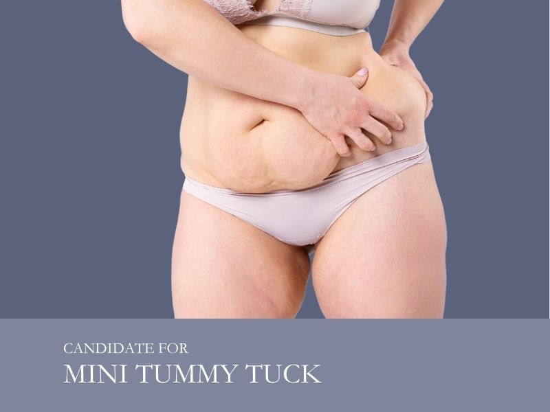 candidate for mini tummy tuck
