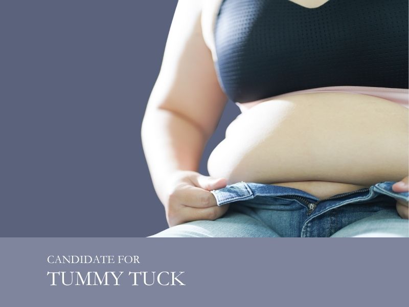 candidate for tummy tuck