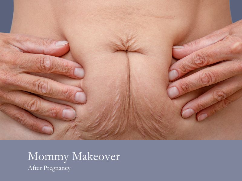 mommy makeover after pregnancy