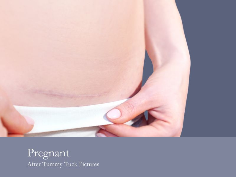 pregnant after tummy tuck pictures